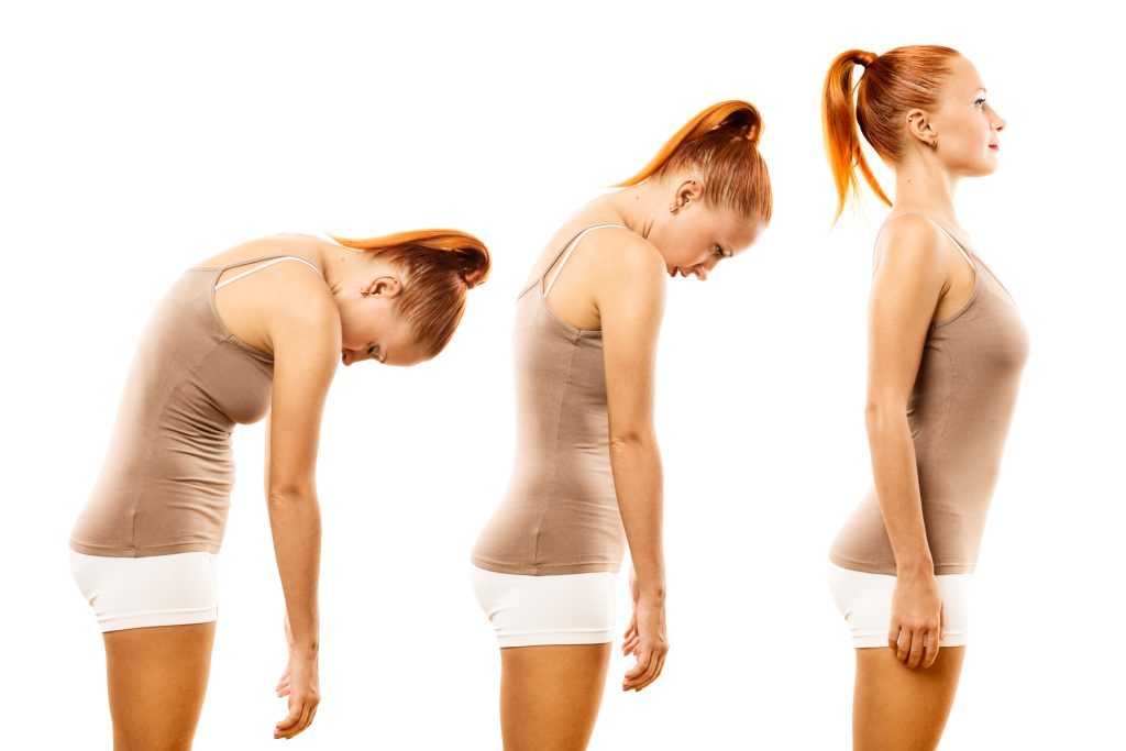 Stages of Sway Back Posture